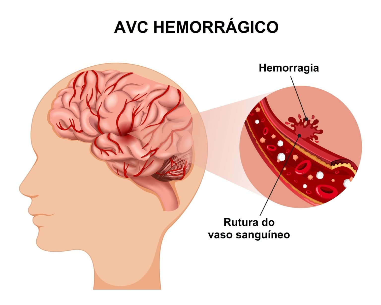 E Depois do AVC? O Papel da Neuropsicologia na Reabilitação